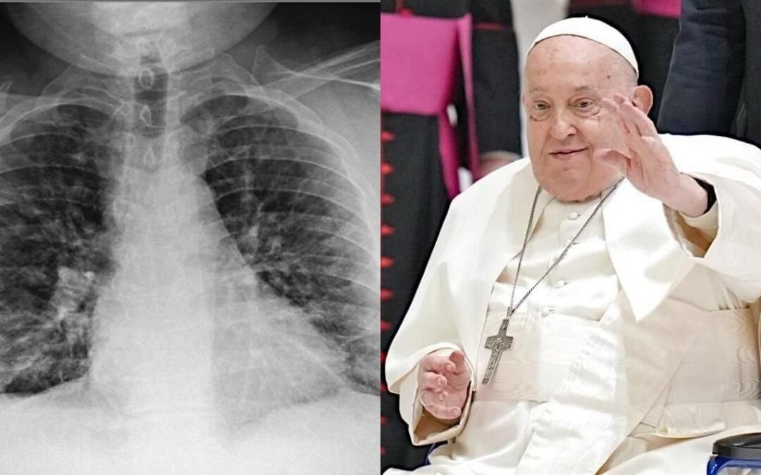 El Sumo Pontífice sufrió dos nuevas crisis respiratorias agudas y su estado es ‘reservado’